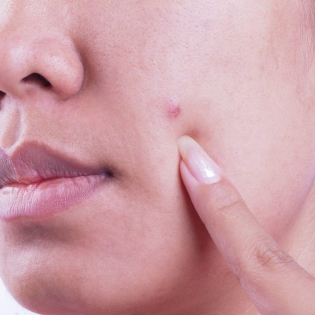 conseils sontre acne