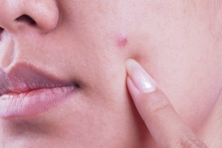 conseils sontre acne